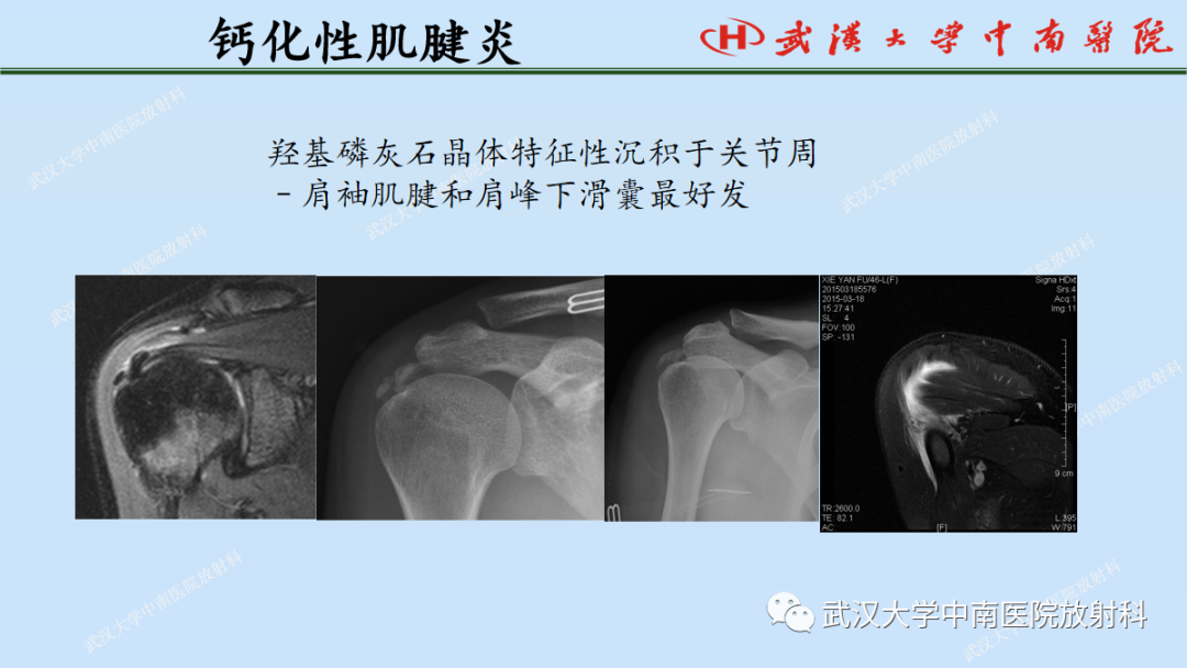 影像PPT - 【PPT】肩关节的MR影像解剖及其慢性损伤-43
