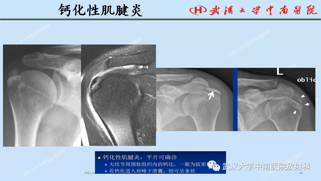 影像PPT - 【PPT】肩关节的MR影像解剖及其慢性损伤-44