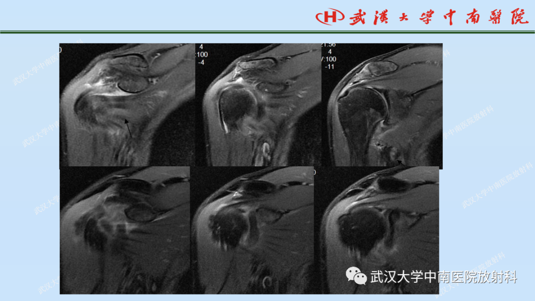 影像PPT - 【PPT】肩关节的MR影像解剖及其慢性损伤-48