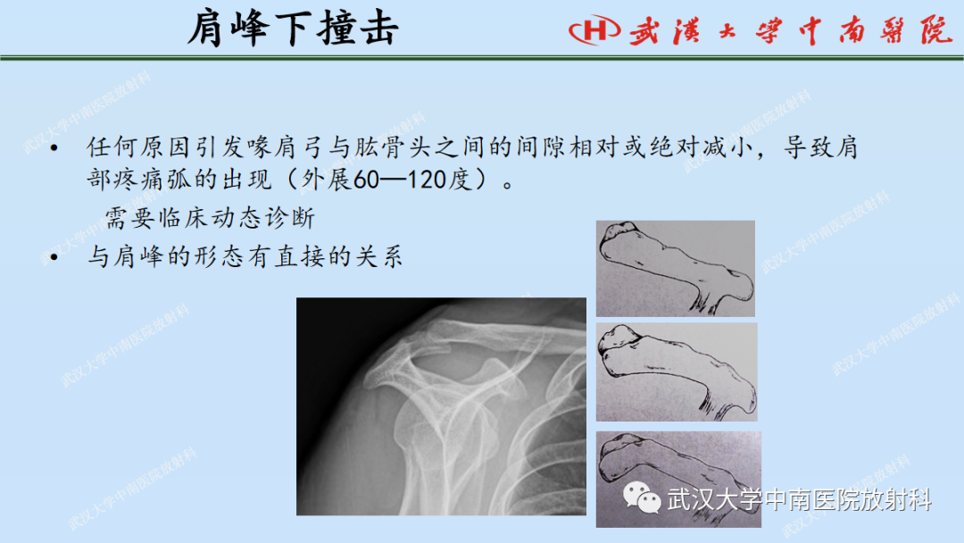 影像PPT - 【PPT】肩关节的MR影像解剖及其慢性损伤-50