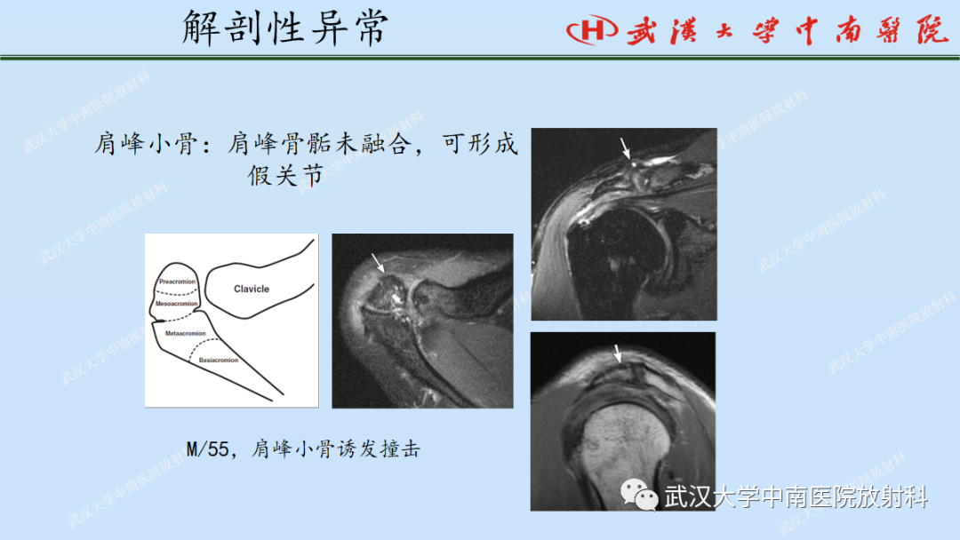影像PPT - 【PPT】肩关节的MR影像解剖及其慢性损伤-54