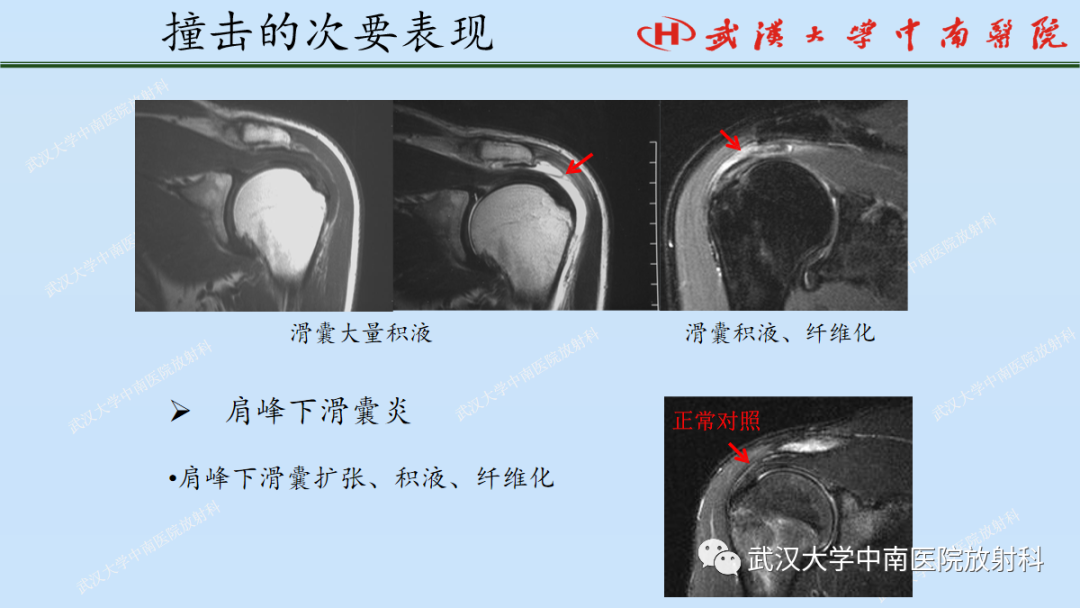 影像PPT - 【PPT】肩关节的MR影像解剖及其慢性损伤-55