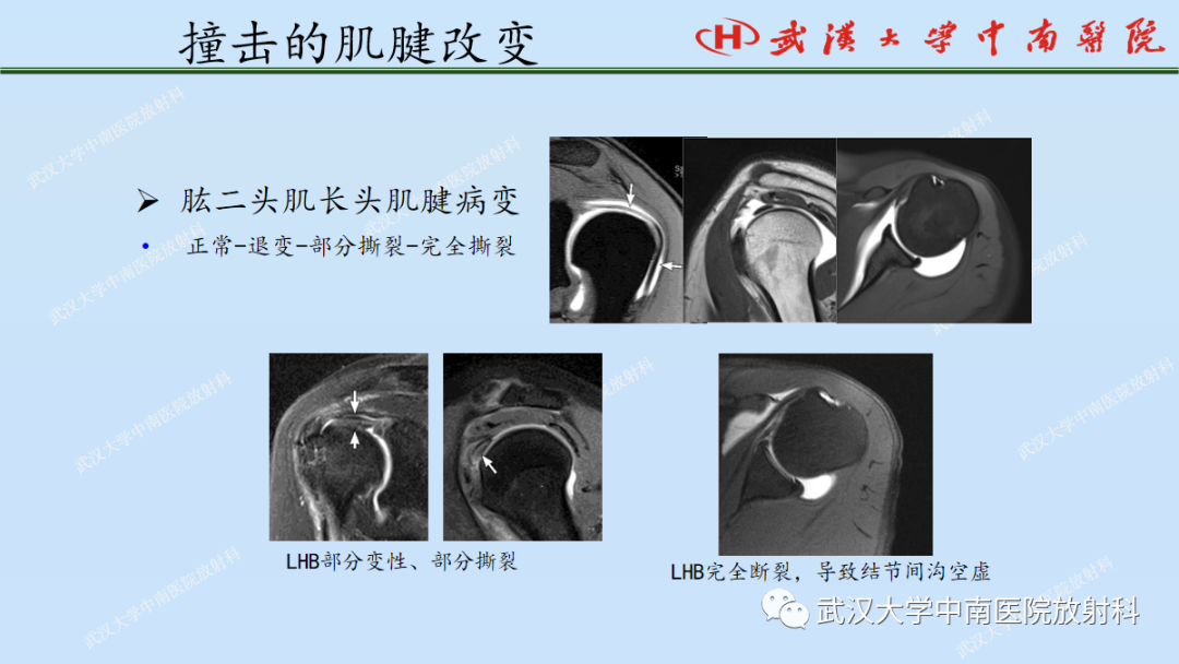 影像PPT - 【PPT】肩关节的MR影像解剖及其慢性损伤-57
