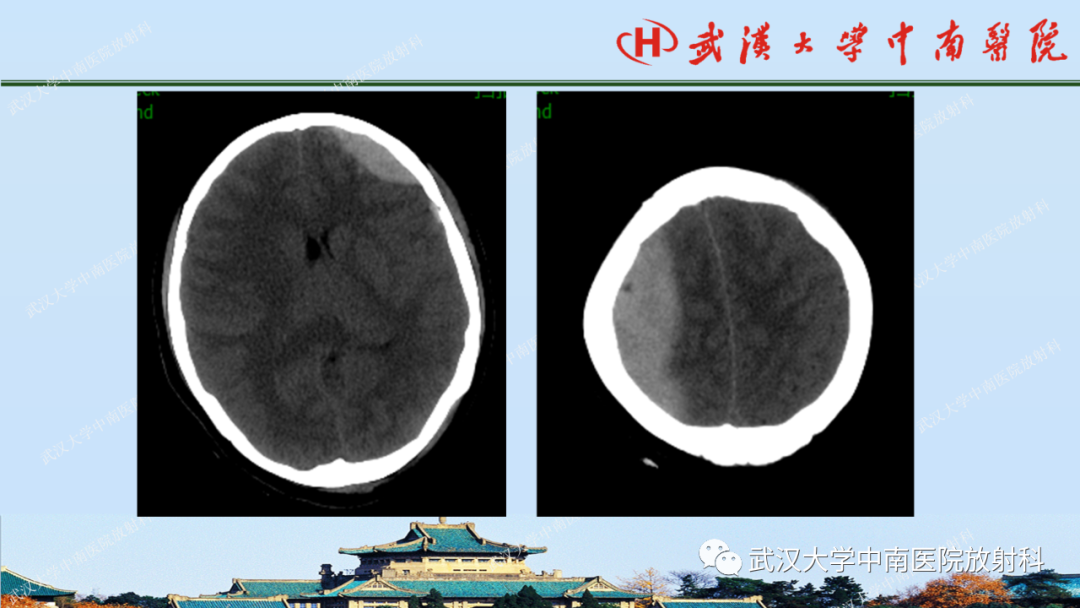 影像PPT - 【PPT】脑外伤影像学诊断-8