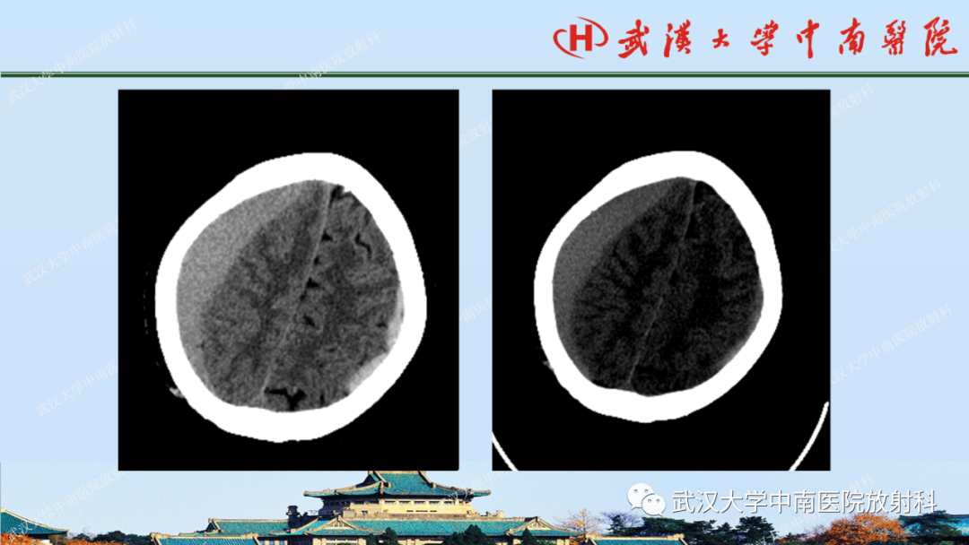 影像PPT - 【PPT】脑外伤影像学诊断-10