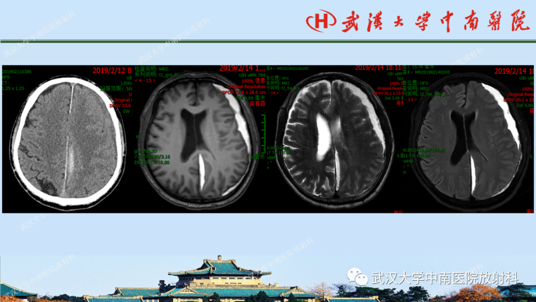 影像PPT - 【PPT】脑外伤影像学诊断-11