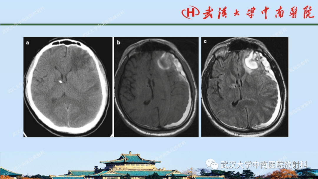 影像PPT - 【PPT】脑外伤影像学诊断-12