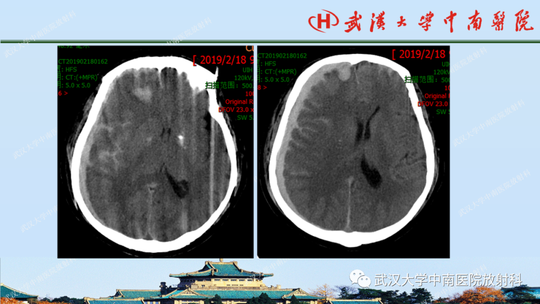 影像PPT - 【PPT】脑外伤影像学诊断-14