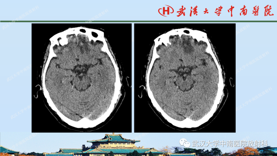 影像PPT - 【PPT】脑外伤影像学诊断-16