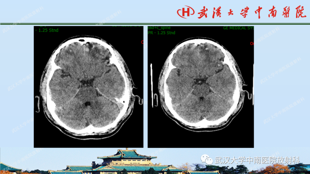 影像PPT - 【PPT】脑外伤影像学诊断-17