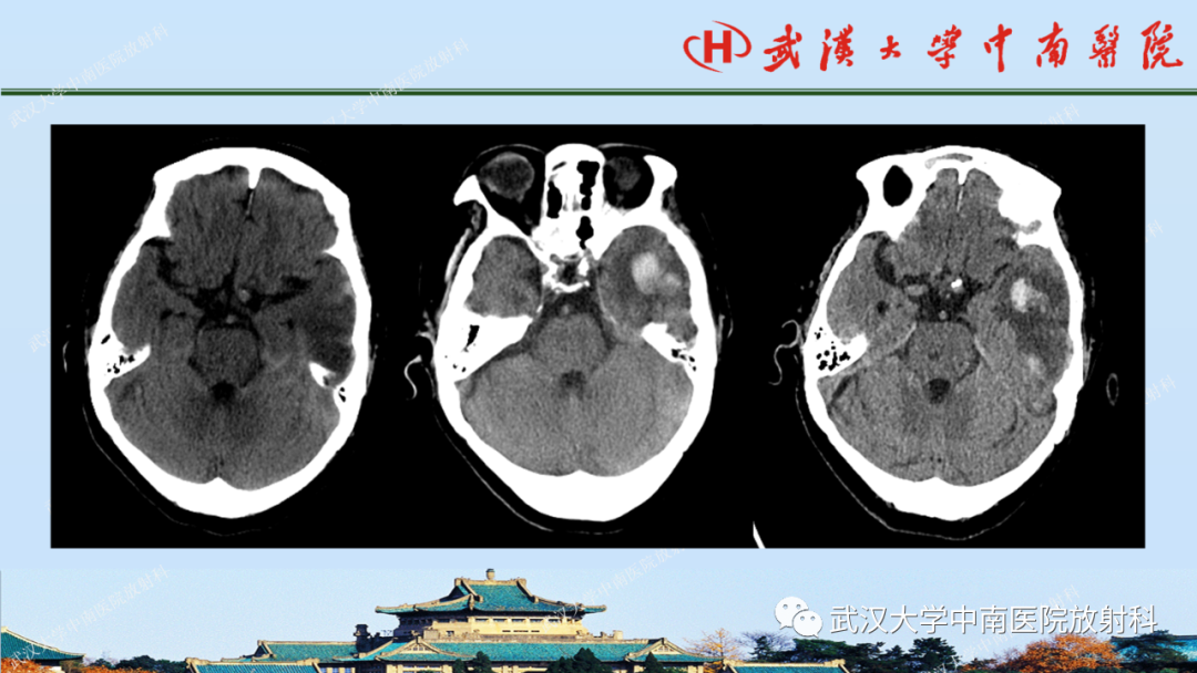 影像PPT - 【PPT】脑外伤影像学诊断-18