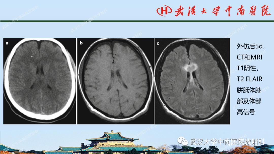 影像PPT - 【PPT】脑外伤影像学诊断-21