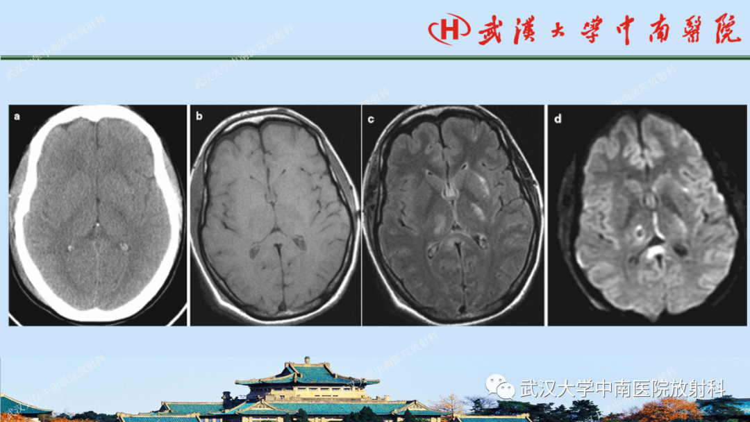 影像PPT - 【PPT】脑外伤影像学诊断-22