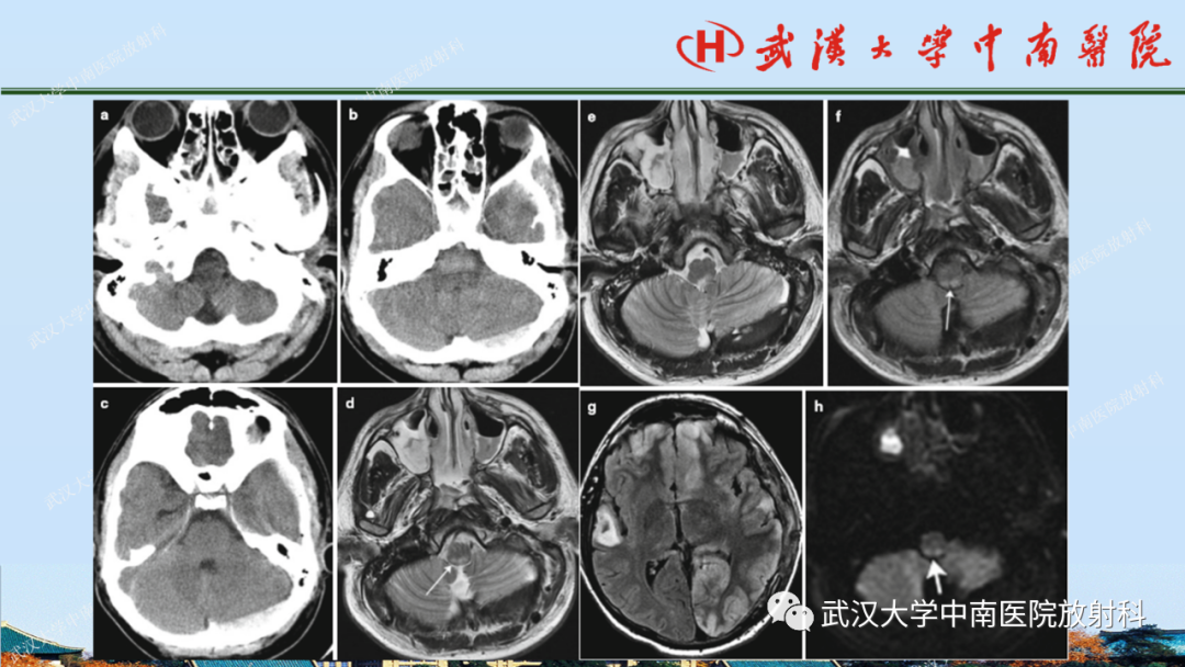 影像PPT - 【PPT】脑外伤影像学诊断-24