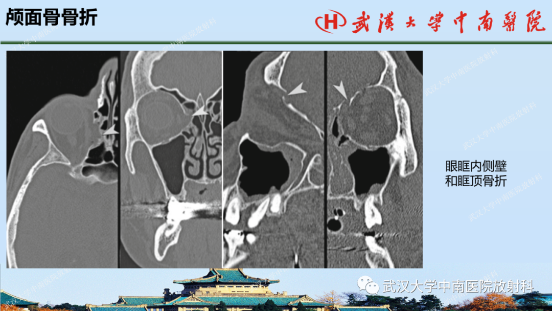 影像PPT - 【PPT】脑外伤影像学诊断-27