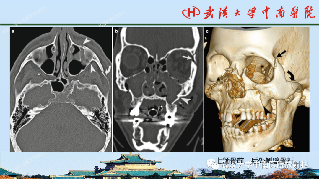 影像PPT - 【PPT】脑外伤影像学诊断-28