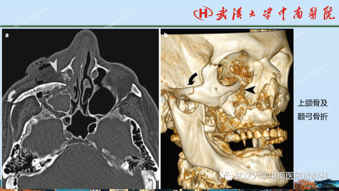 影像PPT - 【PPT】脑外伤影像学诊断-29