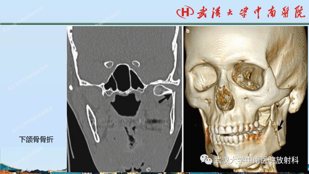 影像PPT - 【PPT】脑外伤影像学诊断-31