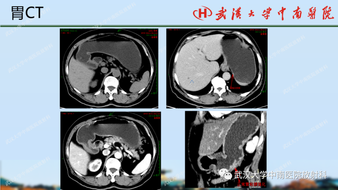 影像PPT - 【PPT】胃占位病变影像诊断分析-6