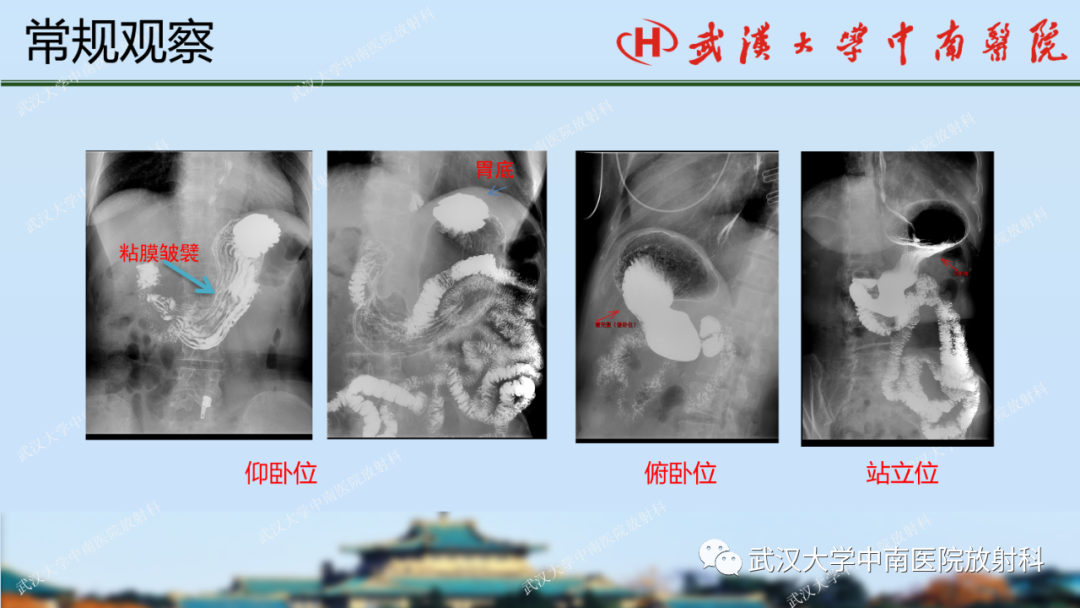 影像PPT - 【PPT】胃占位病变影像诊断分析-10