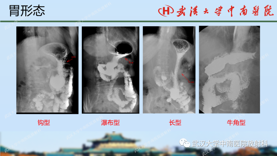 影像PPT - 【PPT】胃占位病变影像诊断分析-9