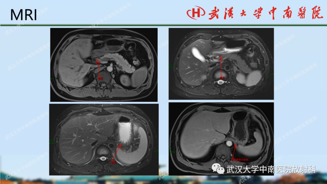 影像PPT - 【PPT】胃占位病变影像诊断分析-12