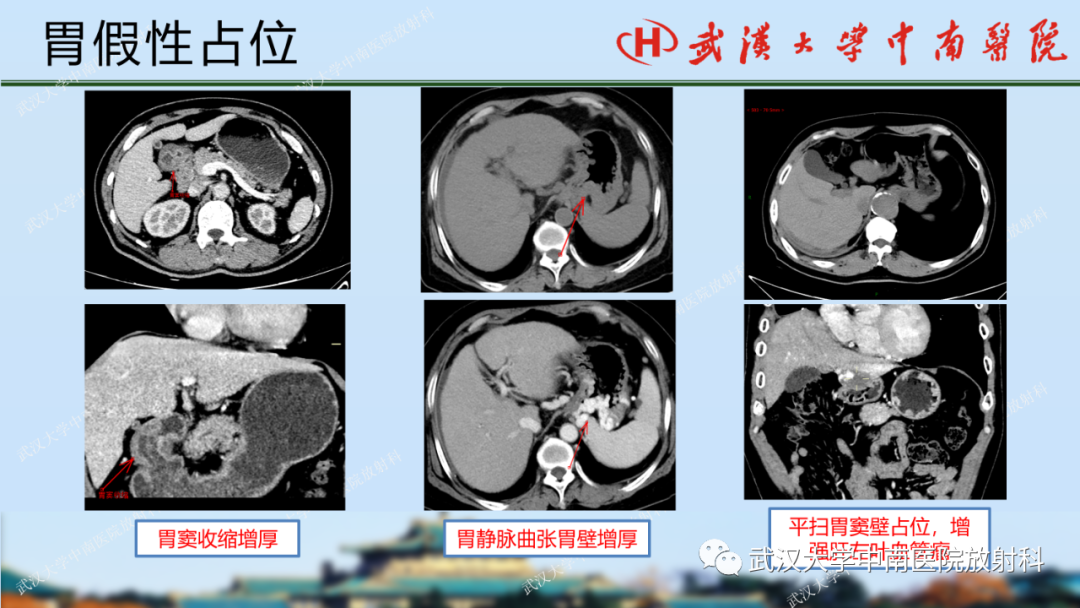 影像PPT - 【PPT】胃占位病变影像诊断分析-17