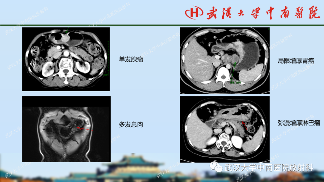 影像PPT - 【PPT】胃占位病变影像诊断分析-20