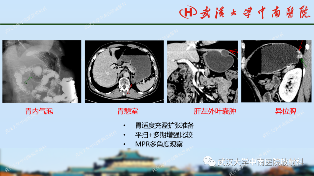 影像PPT - 【PPT】胃占位病变影像诊断分析-18