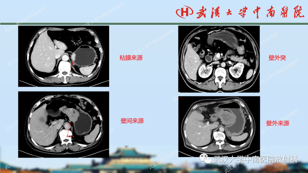 影像PPT - 【PPT】胃占位病变影像诊断分析-22