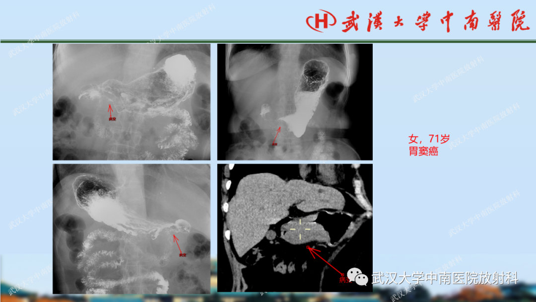 影像PPT - 【PPT】胃占位病变影像诊断分析-23