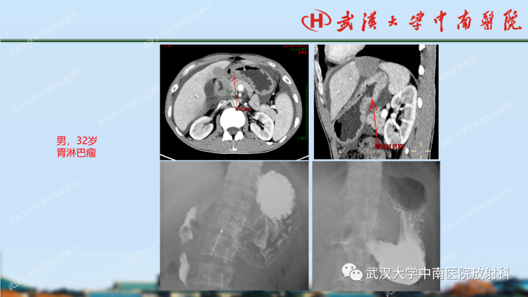 影像PPT - 【PPT】胃占位病变影像诊断分析-24