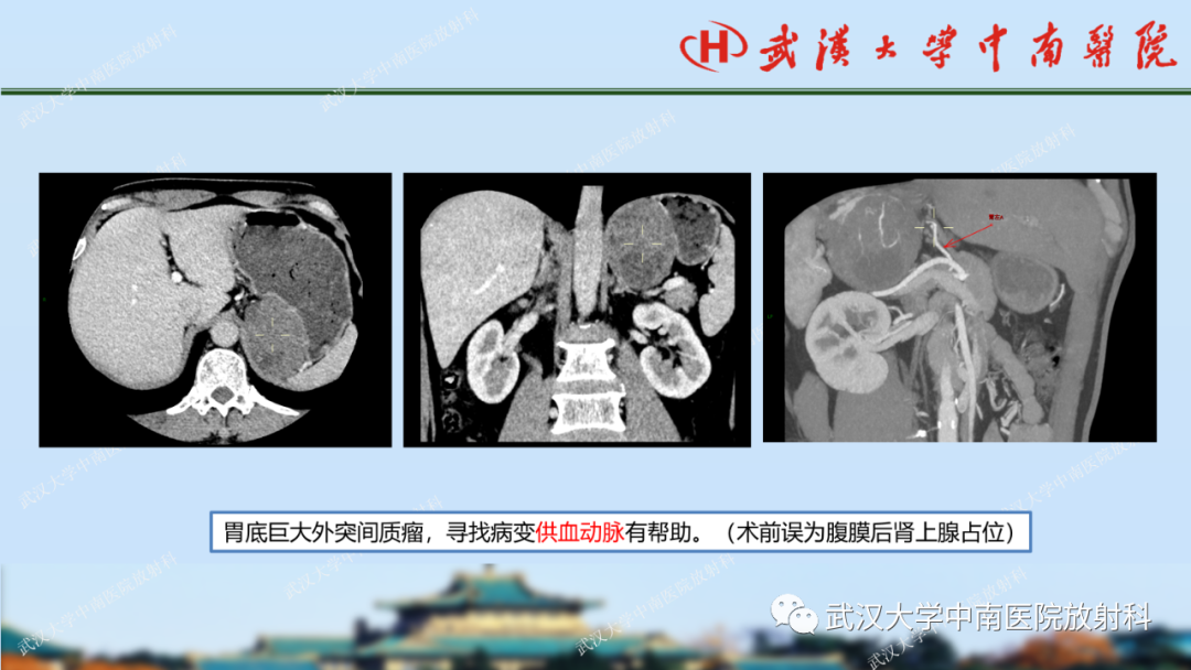 影像PPT - 【PPT】胃占位病变影像诊断分析-26