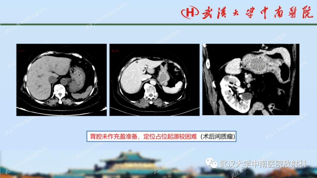 影像PPT - 【PPT】胃占位病变影像诊断分析-25