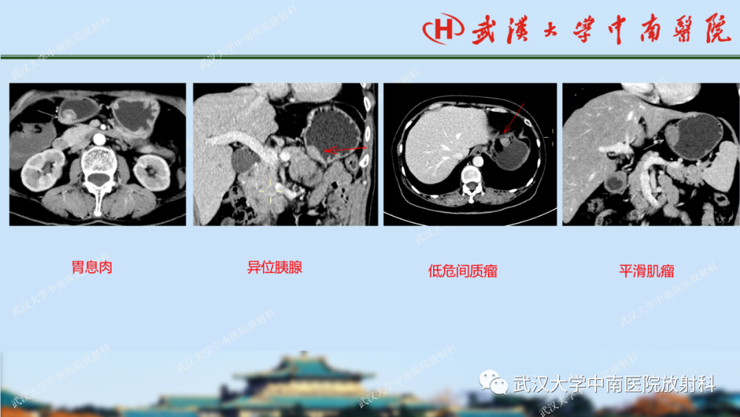 影像PPT - 【PPT】胃占位病变影像诊断分析-28