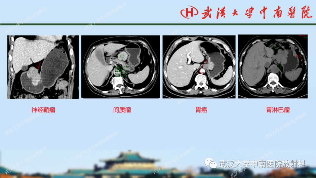 影像PPT - 【PPT】胃占位病变影像诊断分析-29
