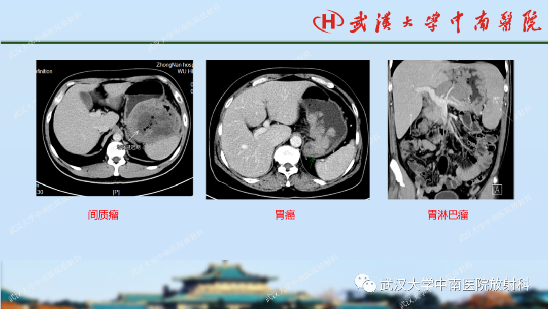 影像PPT - 【PPT】胃占位病变影像诊断分析-30