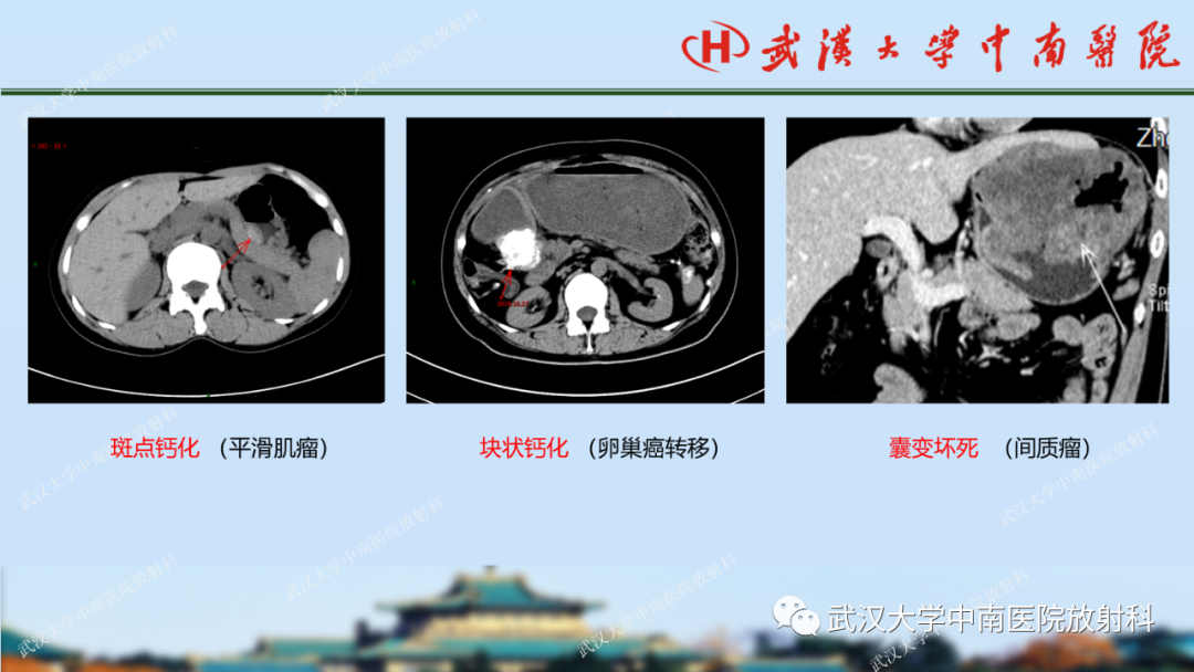 影像PPT - 【PPT】胃占位病变影像诊断分析-32