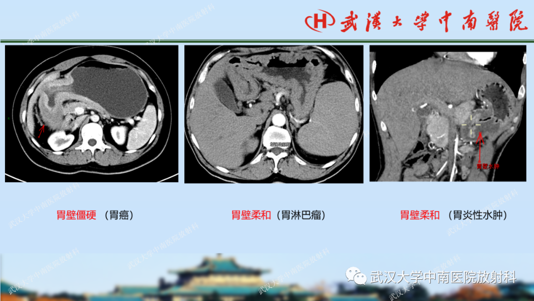 影像PPT - 【PPT】胃占位病变影像诊断分析-33