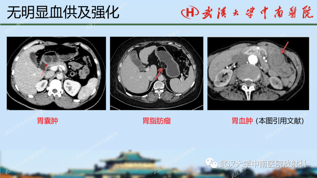 影像PPT - 【PPT】胃占位病变影像诊断分析-35
