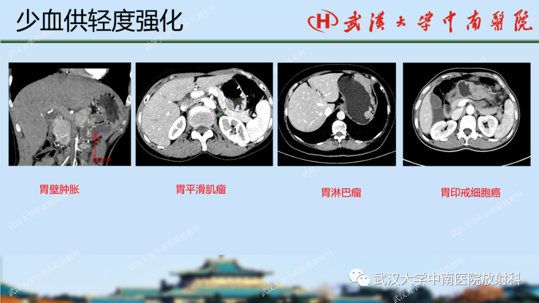 影像PPT - 【PPT】胃占位病变影像诊断分析-36