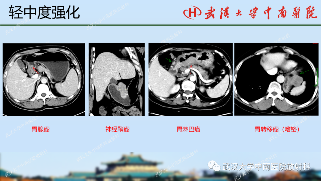 影像PPT - 【PPT】胃占位病变影像诊断分析-37