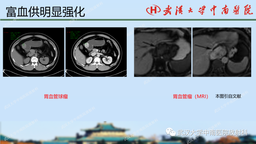 影像PPT - 【PPT】胃占位病变影像诊断分析-39