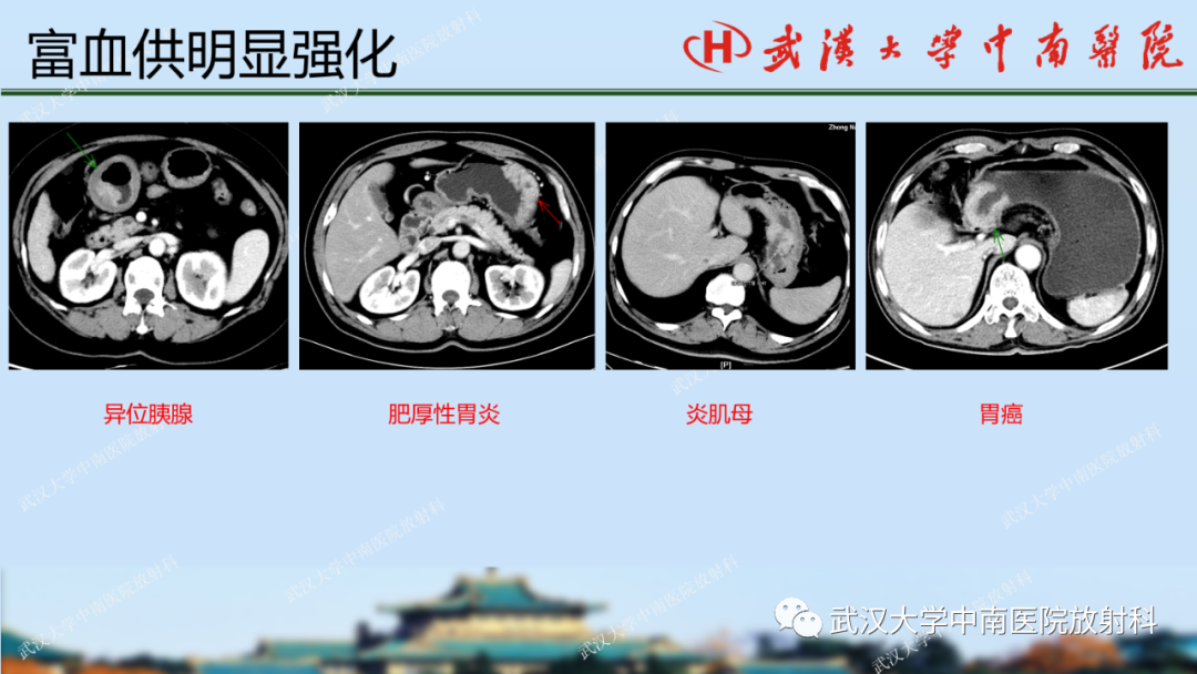 影像PPT - 【PPT】胃占位病变影像诊断分析-38