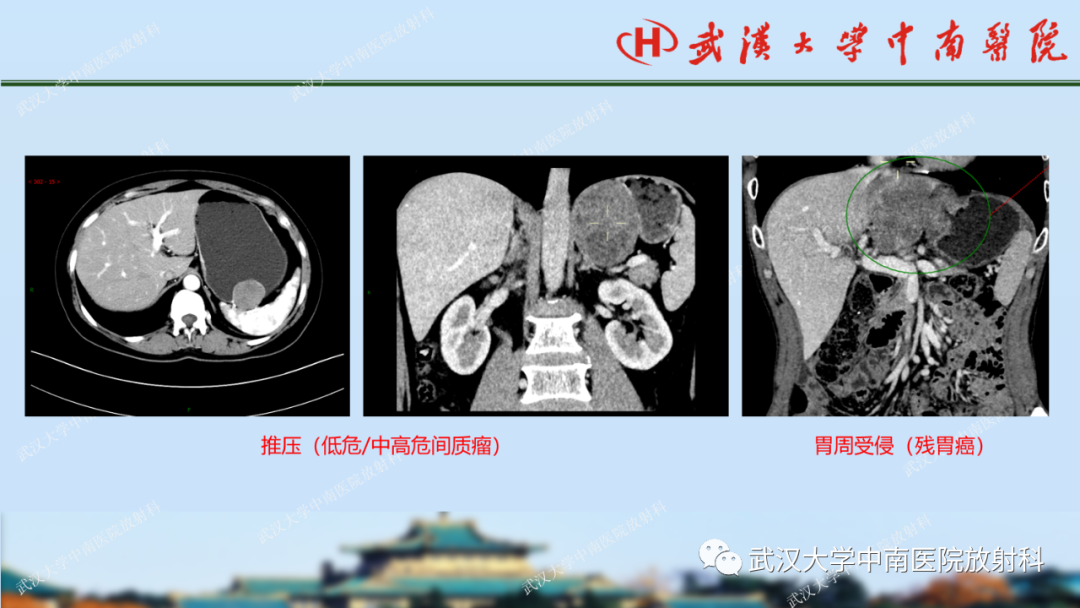 影像PPT - 【PPT】胃占位病变影像诊断分析-41