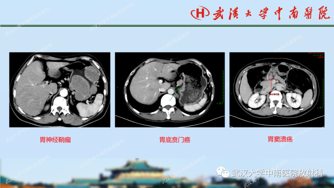 影像PPT - 【PPT】胃占位病变影像诊断分析-42
