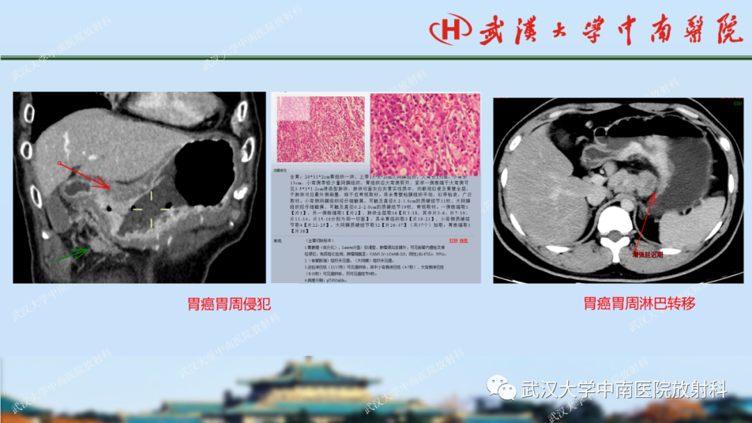 影像PPT - 【PPT】胃占位病变影像诊断分析-44