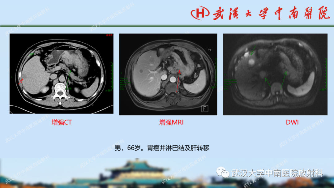 影像PPT - 【PPT】胃占位病变影像诊断分析-45