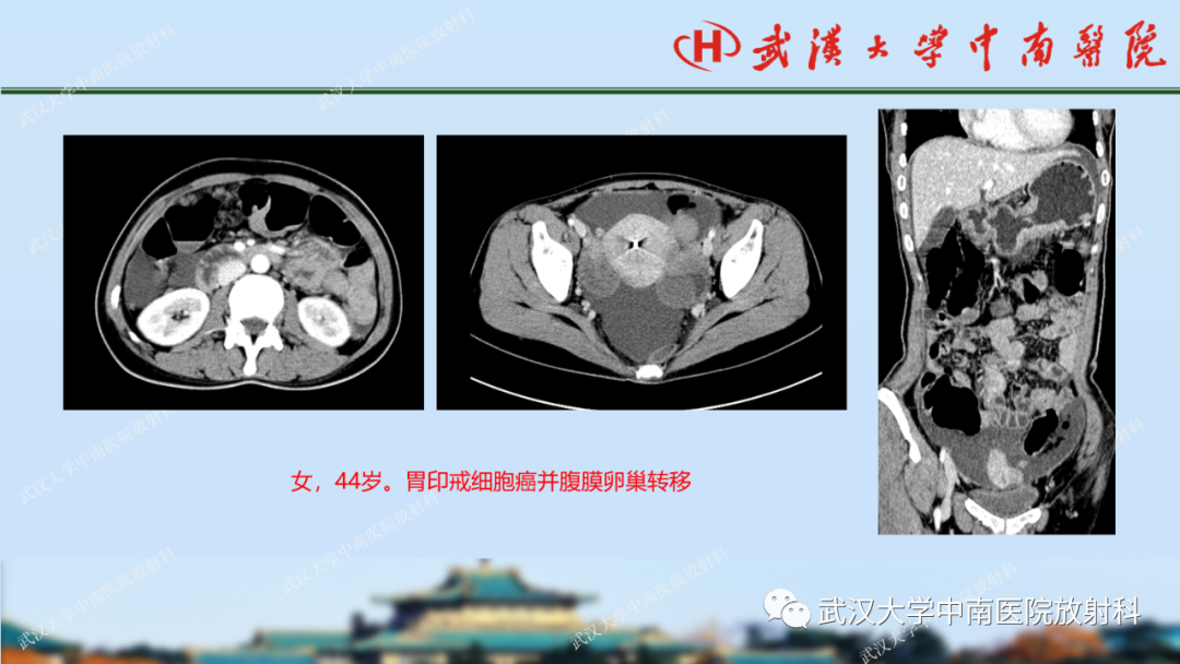 影像PPT - 【PPT】胃占位病变影像诊断分析-46