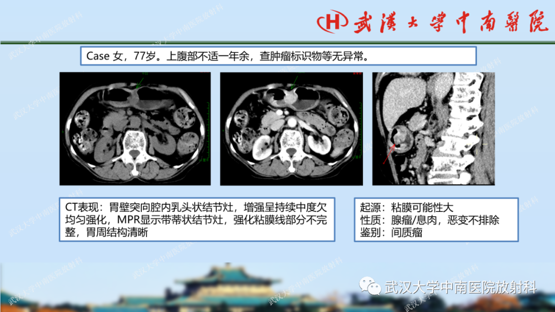 影像PPT - 【PPT】胃占位病变影像诊断分析-50
